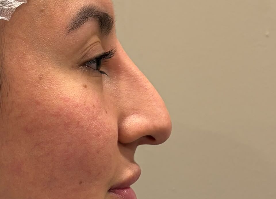 Rinoplastia Dra Carla Mora Pulido