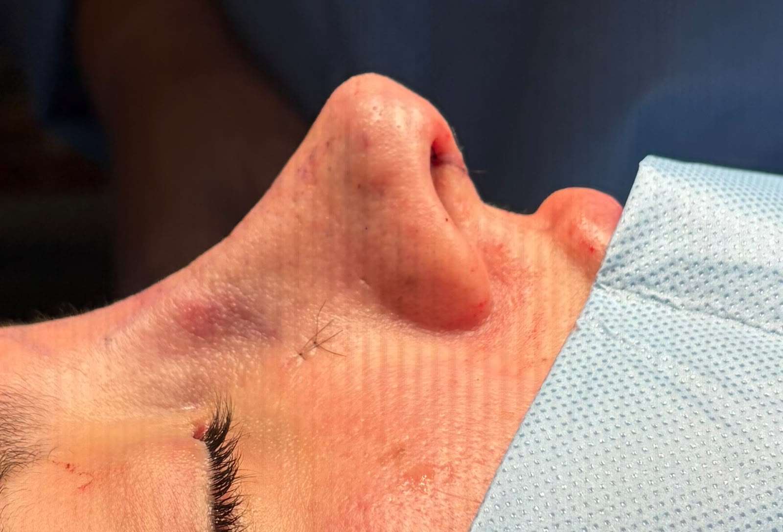 Rinoseptoplastia Dra Carla Mora Pulido