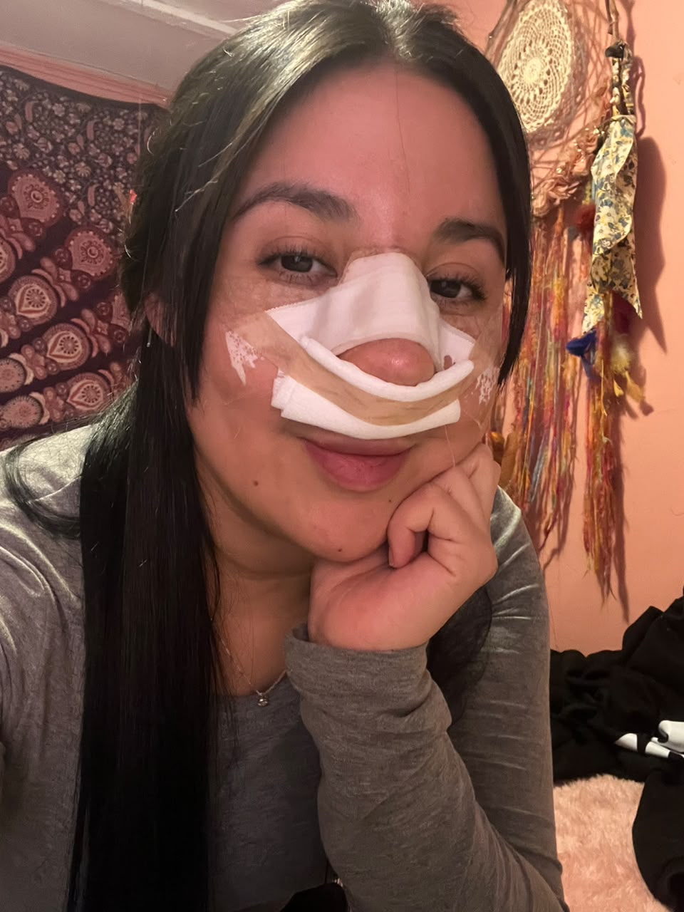 Rinoplastia 1 semana