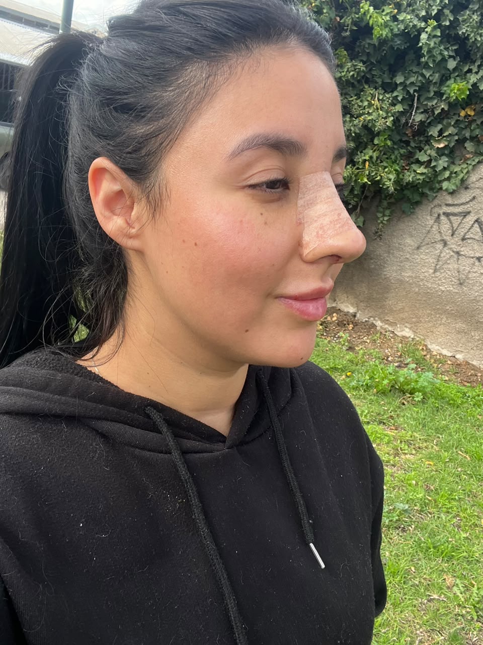 Rinoplastia 1 semana de recuperación