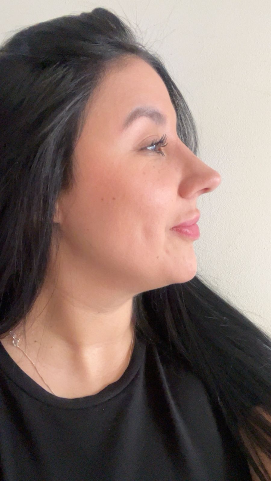 Rinoplastia 1 mes de recuperación